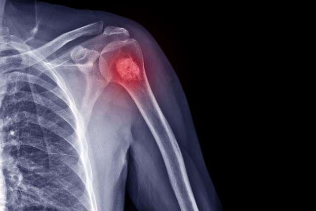 肩部x线片显示内软骨瘤病.