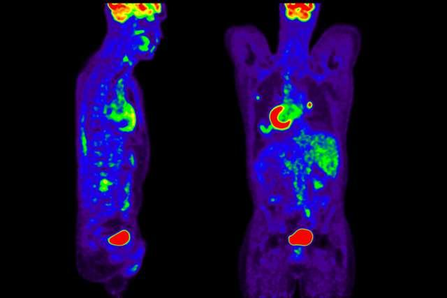PET/CT scan for nuclear medicine